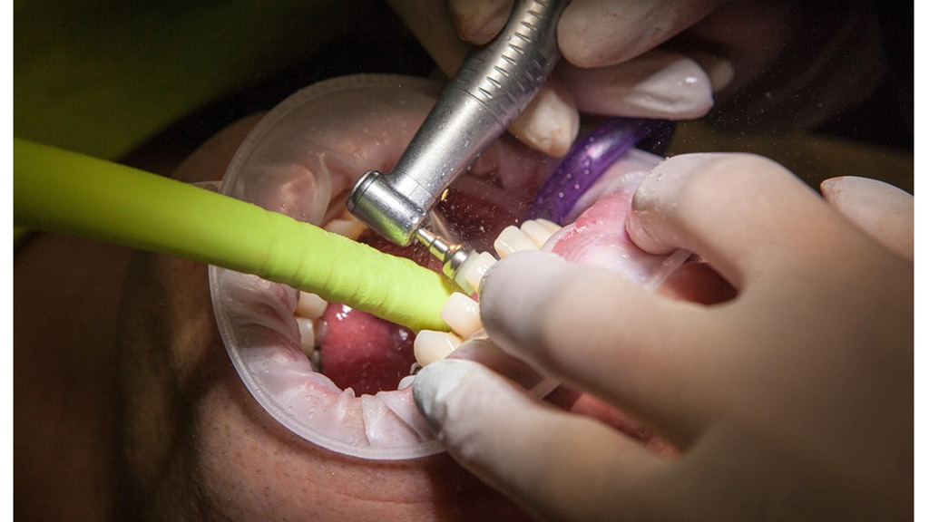Inflammatorisk tarmsjukdom ökar risken för tandlossning